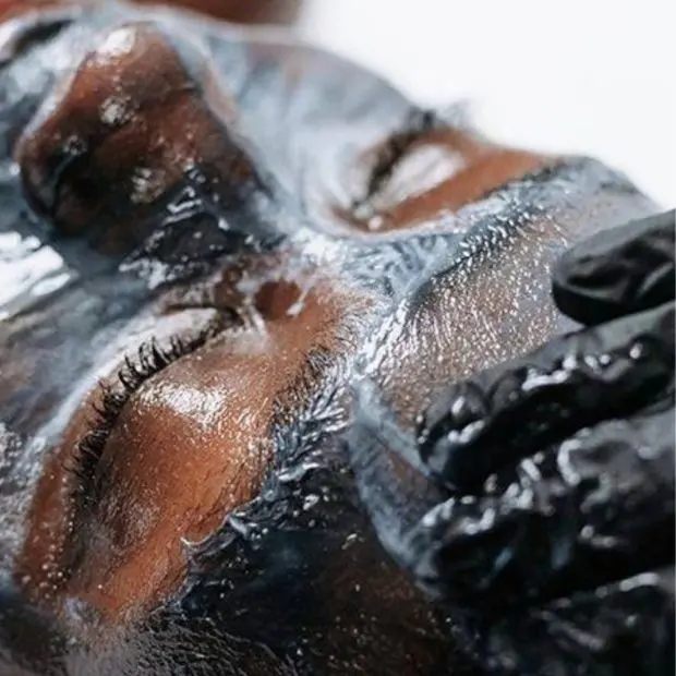 Blue LED acne therapy