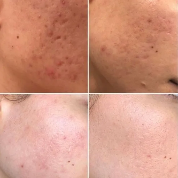Chemical peel application