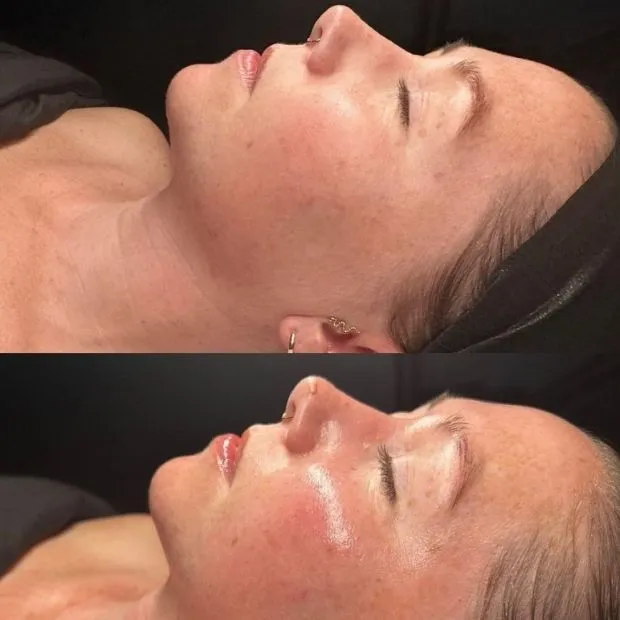 Professional Peel before and after — smoother texture