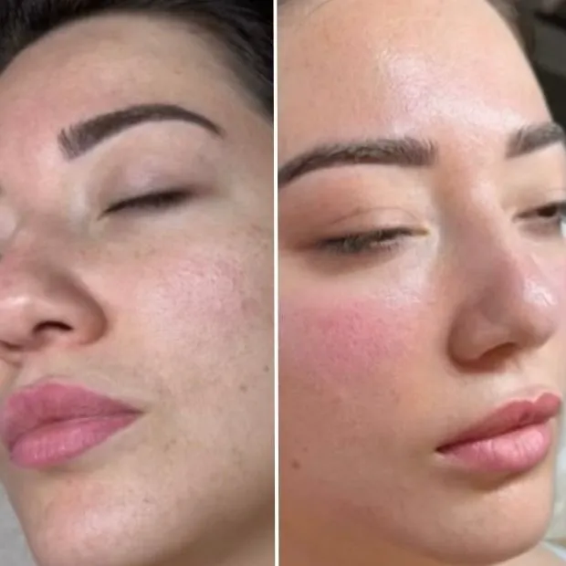 Deep Cleansing Facial before and after — Crown of Beauty Skincare New Hope PA